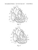 Percutaneous Valve Repair by Reshaping and Resizing Right Ventricle diagram and image