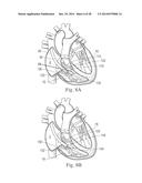 Percutaneous Valve Repair by Reshaping and Resizing Right Ventricle diagram and image