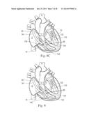 Percutaneous Valve Repair by Reshaping and Resizing Right Ventricle diagram and image