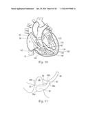 Percutaneous Valve Repair by Reshaping and Resizing Right Ventricle diagram and image