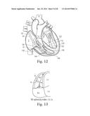 Percutaneous Valve Repair by Reshaping and Resizing Right Ventricle diagram and image