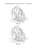 Percutaneous Valve Repair by Reshaping and Resizing Right Ventricle diagram and image