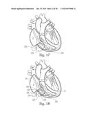 Percutaneous Valve Repair by Reshaping and Resizing Right Ventricle diagram and image