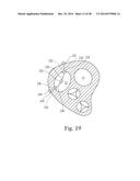 Percutaneous Valve Repair by Reshaping and Resizing Right Ventricle diagram and image