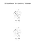 Percutaneous Valve Repair by Reshaping and Resizing Right Ventricle diagram and image