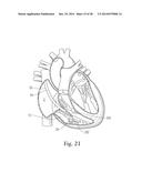 Percutaneous Valve Repair by Reshaping and Resizing Right Ventricle diagram and image