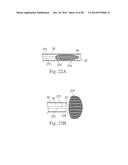 Percutaneous Valve Repair by Reshaping and Resizing Right Ventricle diagram and image