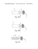 Percutaneous Valve Repair by Reshaping and Resizing Right Ventricle diagram and image