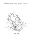 Percutaneous Valve Repair by Reshaping and Resizing Right Ventricle diagram and image