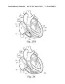 Percutaneous Valve Repair by Reshaping and Resizing Right Ventricle diagram and image