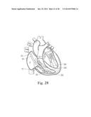 Percutaneous Valve Repair by Reshaping and Resizing Right Ventricle diagram and image