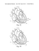 Percutaneous Valve Repair by Reshaping and Resizing Right Ventricle diagram and image