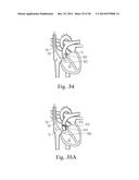 Percutaneous Valve Repair by Reshaping and Resizing Right Ventricle diagram and image