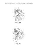 Percutaneous Valve Repair by Reshaping and Resizing Right Ventricle diagram and image