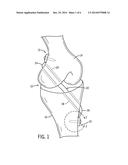 SOFT TISSUE ATTACHMENT DEVICE diagram and image