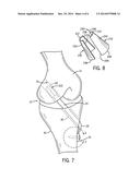 SOFT TISSUE ATTACHMENT DEVICE diagram and image