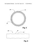 FLEXIBLE STENT diagram and image