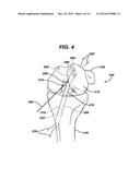 Method of Performing Anterior Cruciate Ligament Reconstruction Using     Biodegradable Interference Screw diagram and image