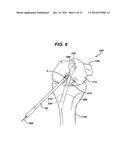 Method of Performing Anterior Cruciate Ligament Reconstruction Using     Biodegradable Interference Screw diagram and image