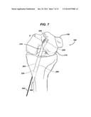 Method of Performing Anterior Cruciate Ligament Reconstruction Using     Biodegradable Interference Screw diagram and image