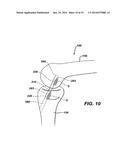Method of Performing Anterior Cruciate Ligament Reconstruction Using     Biodegradable Interference Screw diagram and image