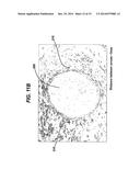 Method of Performing Anterior Cruciate Ligament Reconstruction Using     Biodegradable Interference Screw diagram and image