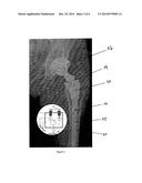 IN-VIVO CONDITION MONITORING OF METALLIC IMPLANTS BY ELECTROCHEMICAL     TECHNIQUES diagram and image