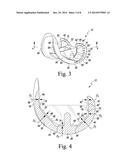 FEMORAL COMPONENT OF A KNEE PROSTHESIS HAVING AN ANGLED CEMENT POCKET diagram and image