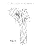 IMPLANT ANCHORING DEVICE diagram and image