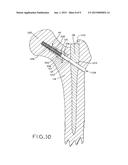 IMPLANT ANCHORING DEVICE diagram and image