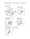 METHODS AND COMPOSITIONS TO TREAT MYOCARDIAL CONDITIONS diagram and image