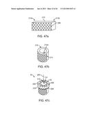 NEEDLE GUARD, ASSEMBLY AND METHOD OF IMPLANTING A HEART ASSIST SYSTEM diagram and image