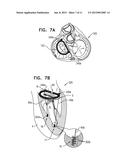 IMPLANT HAVING MULTIPLE ROTATIONAL ASSEMBLIES diagram and image