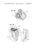 IMPLANT HAVING MULTIPLE ROTATIONAL ASSEMBLIES diagram and image