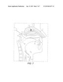 Nasal Delivery Devices diagram and image