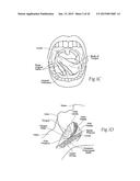 IMPLANTABLE DEVICES, SYSTEMS, AND METHODS FOR MAINTAINING DESIRED     ORIENTATIONS IN TARGETED TISSUE REGIONS diagram and image