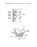 IMPLANTABLE DEVICES, SYSTEMS, AND METHODS FOR MAINTAINING DESIRED     ORIENTATIONS IN TARGETED TISSUE REGIONS diagram and image