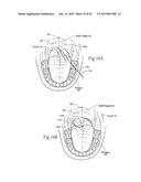 IMPLANTABLE DEVICES, SYSTEMS, AND METHODS FOR MAINTAINING DESIRED     ORIENTATIONS IN TARGETED TISSUE REGIONS diagram and image