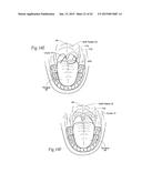 IMPLANTABLE DEVICES, SYSTEMS, AND METHODS FOR MAINTAINING DESIRED     ORIENTATIONS IN TARGETED TISSUE REGIONS diagram and image