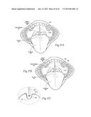 IMPLANTABLE DEVICES, SYSTEMS, AND METHODS FOR MAINTAINING DESIRED     ORIENTATIONS IN TARGETED TISSUE REGIONS diagram and image