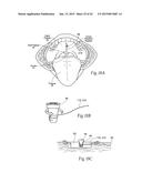 IMPLANTABLE DEVICES, SYSTEMS, AND METHODS FOR MAINTAINING DESIRED     ORIENTATIONS IN TARGETED TISSUE REGIONS diagram and image