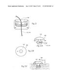 IMPLANTABLE DEVICES, SYSTEMS, AND METHODS FOR MAINTAINING DESIRED     ORIENTATIONS IN TARGETED TISSUE REGIONS diagram and image