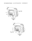 IMPLANTABLE DEVICES, SYSTEMS, AND METHODS FOR MAINTAINING DESIRED     ORIENTATIONS IN TARGETED TISSUE REGIONS diagram and image