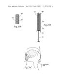 IMPLANTABLE DEVICES, SYSTEMS, AND METHODS FOR MAINTAINING DESIRED     ORIENTATIONS IN TARGETED TISSUE REGIONS diagram and image