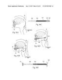 IMPLANTABLE DEVICES, SYSTEMS, AND METHODS FOR MAINTAINING DESIRED     ORIENTATIONS IN TARGETED TISSUE REGIONS diagram and image