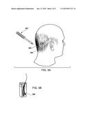 HAIR FOLLICLES MADE EX VIVO THAT CAN BE INSERTED INTO A RECIPIENT FOR HAIR     RESTORATION diagram and image