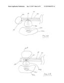 SYSTEMS AND METHODS FOR TREATING PANCREATIC CANCER diagram and image