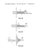 DEVICES AND METHODS FOR GASTROINTESTINAL BYPASS diagram and image