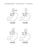 DEVICES AND METHODS FOR GASTROINTESTINAL BYPASS diagram and image