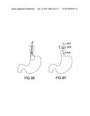 DEVICES AND METHODS FOR GASTROINTESTINAL BYPASS diagram and image